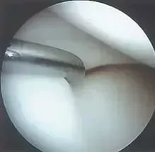 artroskopija-kolena - slika 3