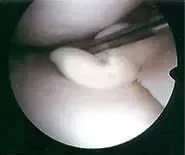 artroskopija-kolena - slika 5