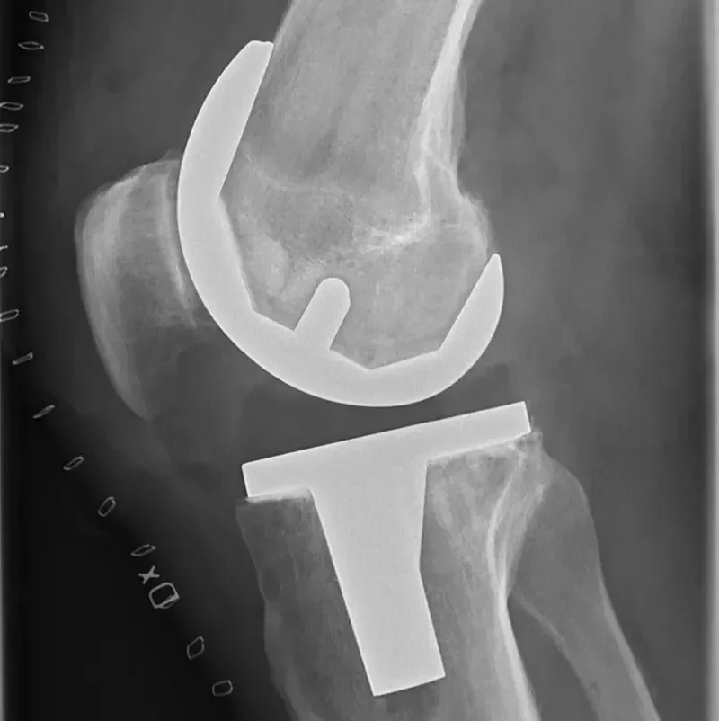 Navodila po endoprotezi kolena