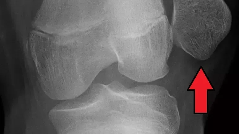 Nestabilnost pogacice