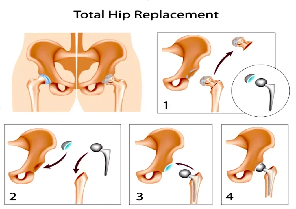 Vaje po endoprotezi kolka